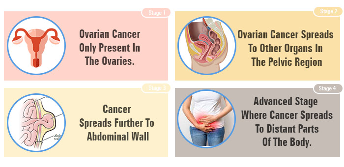 OVARIAN CANCER STAGES