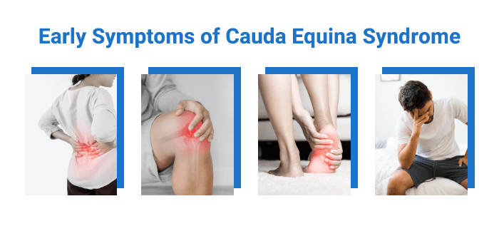 Early Symptoms of Cauda Equina Syndrome