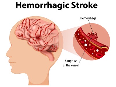 Haemorrhagic-Stroke